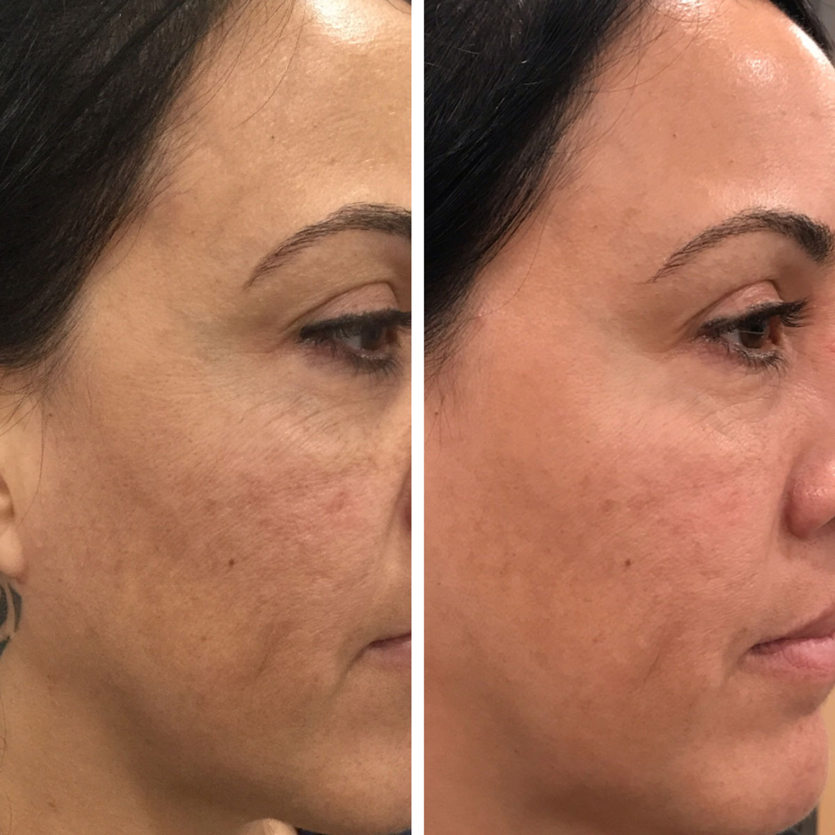 Laser Skin Tightening in San Diego, CA