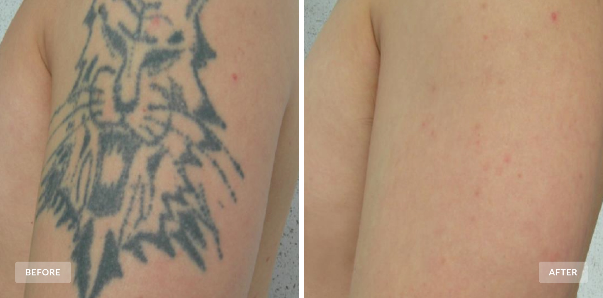 Tattoo Removal San Diego  Laser Tattoo Removal Carlsbad