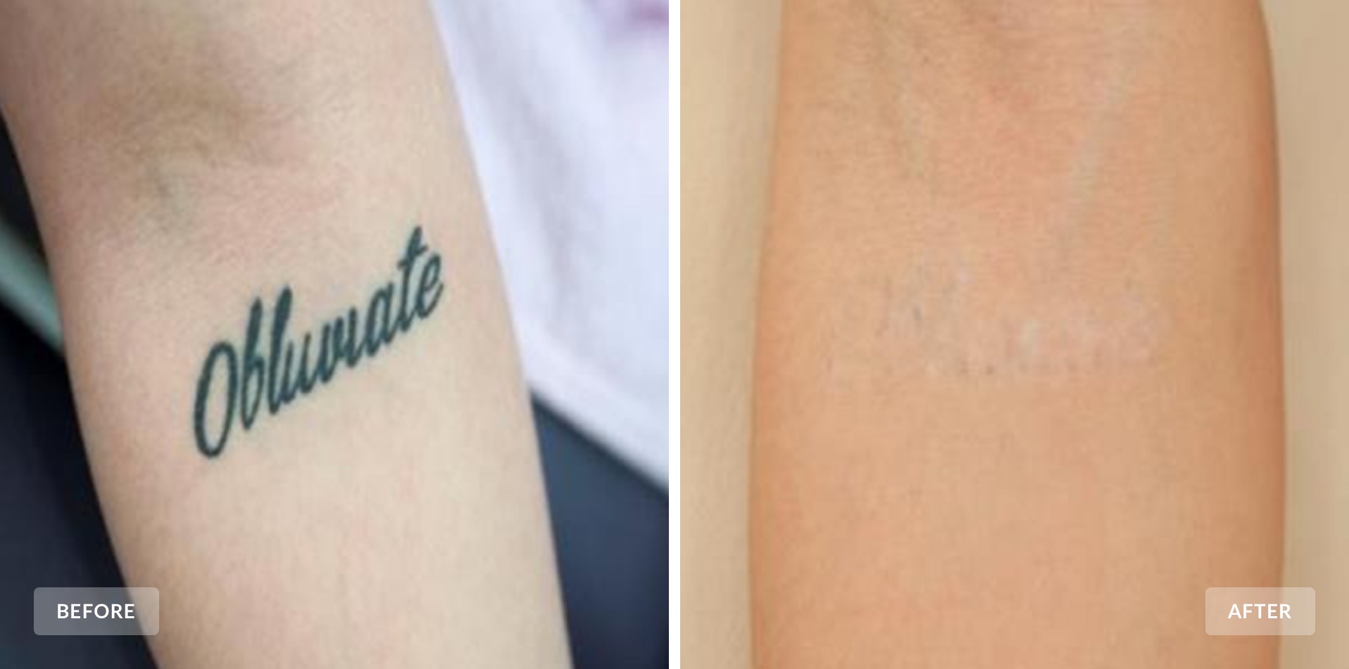 San Diego Laser Tattoo Removal Clinic   REALISTIC PROGRESS PICTURES  3 treatments SO FAR Honesty and Integrity ALWAYS Treatments starting Only  79 Tattoo Removal Guarantee Free Consultations Quanta Discovery Pico Laser