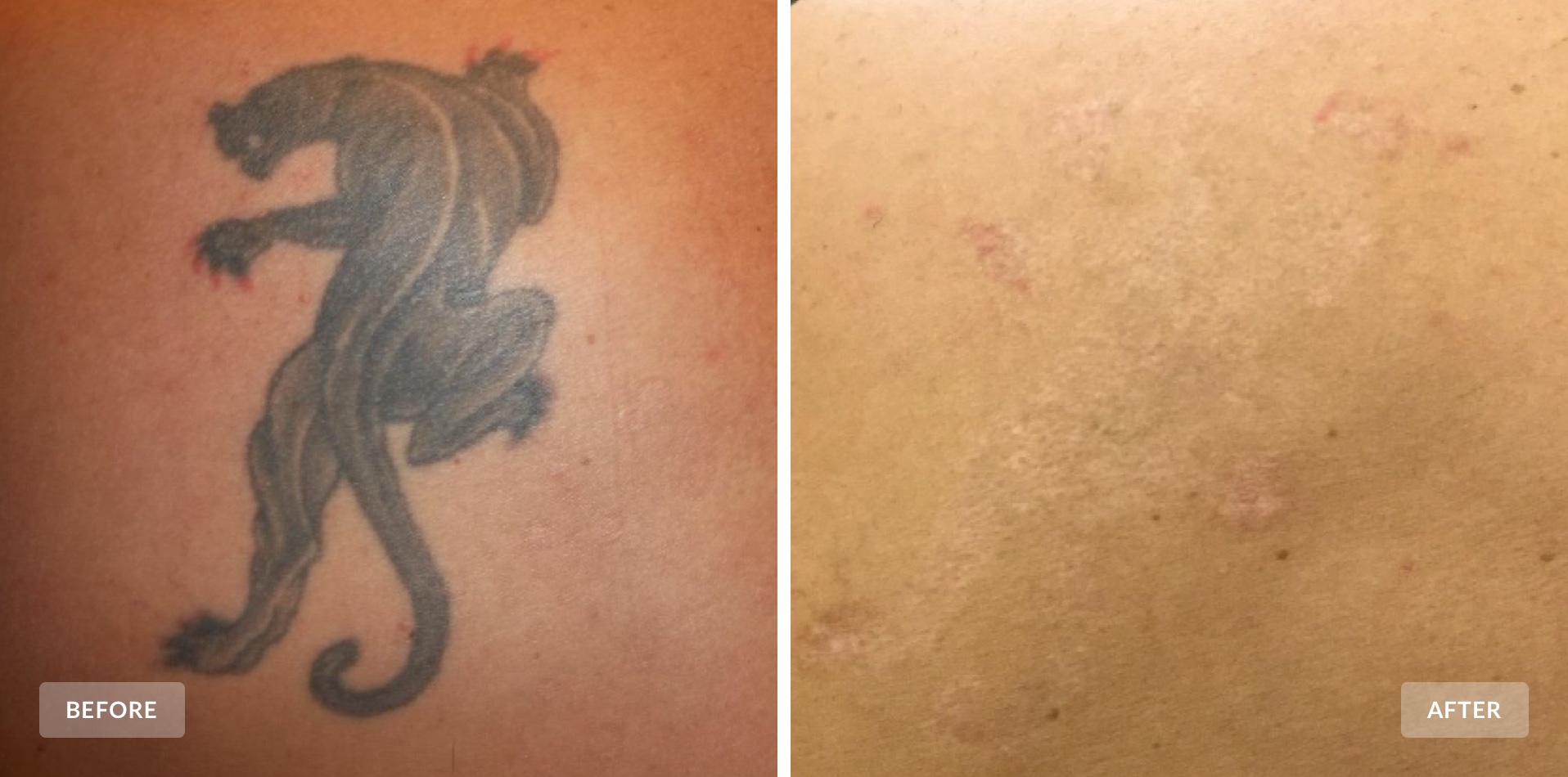 Laser Tattoo Removal San Diego | PICO Laser | MedDerm